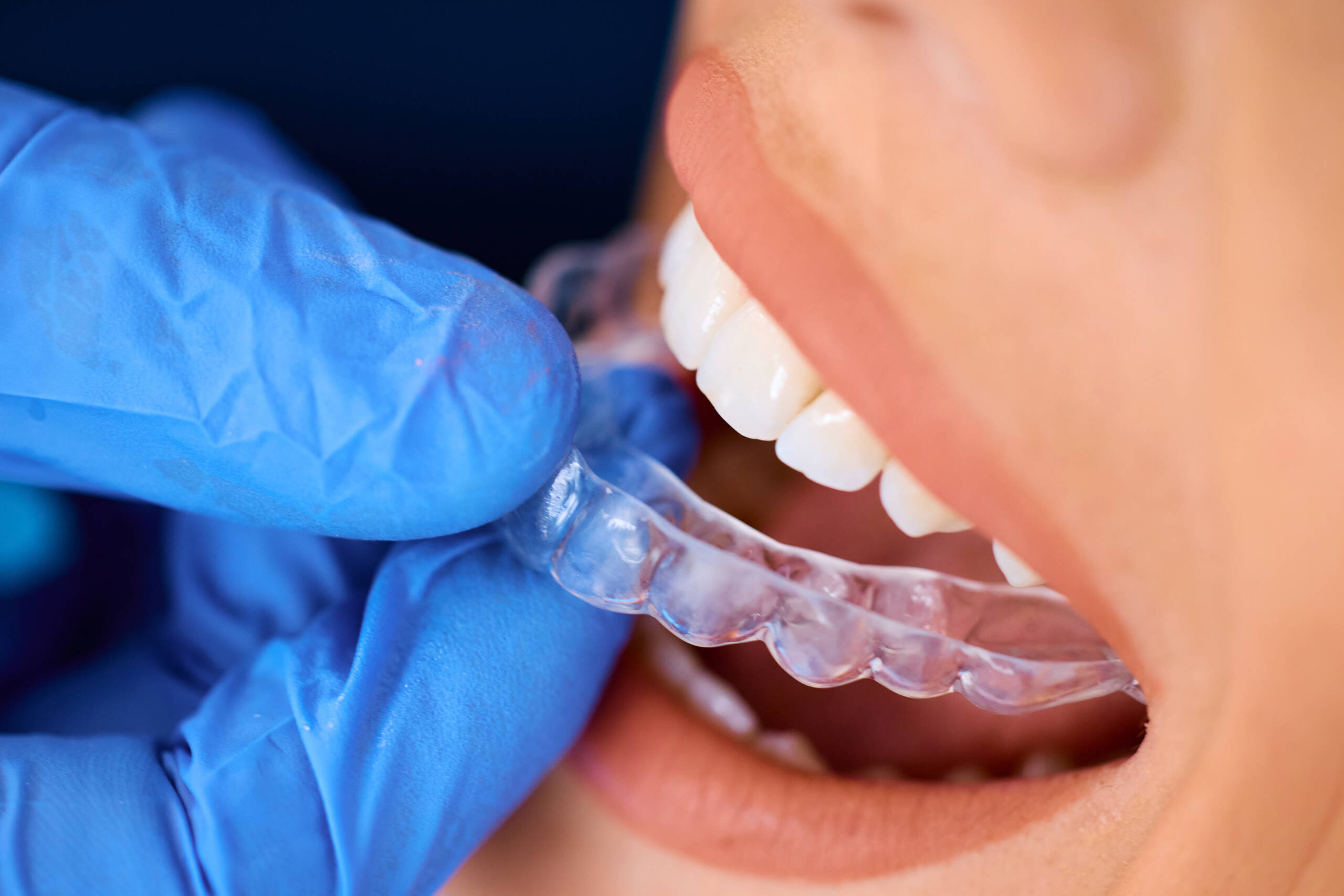 Clear Aligners and Orthodontic Retainers