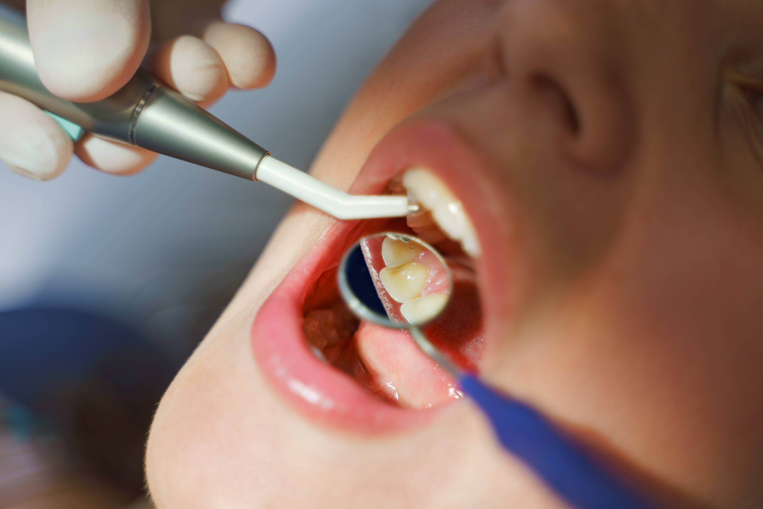 Composite Fillings and Restorations
